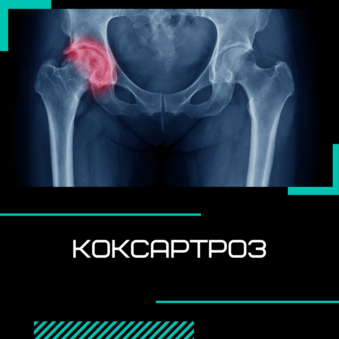 Коксартроз 2 степени симптомы. Распространенность коксартроза.