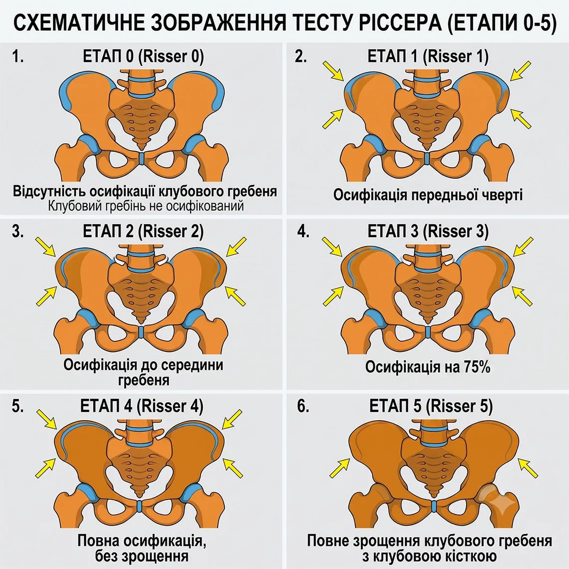 Тест Ріссера, діагностика сколіозу
