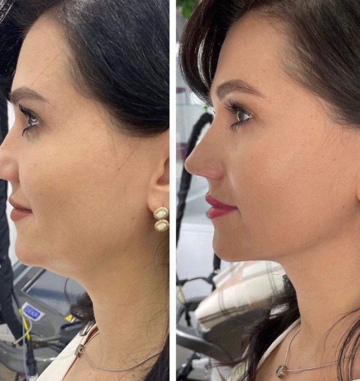 До і після SMAS-ліфтингу, фото 5 — Smart Beauty Clinic, Кривий Ріг