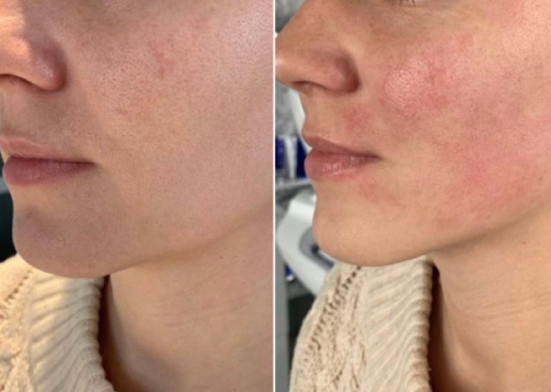 До і після SMAS-ліфтингу, фото 4 — Smart Beauty Clinic, Кривий Ріг