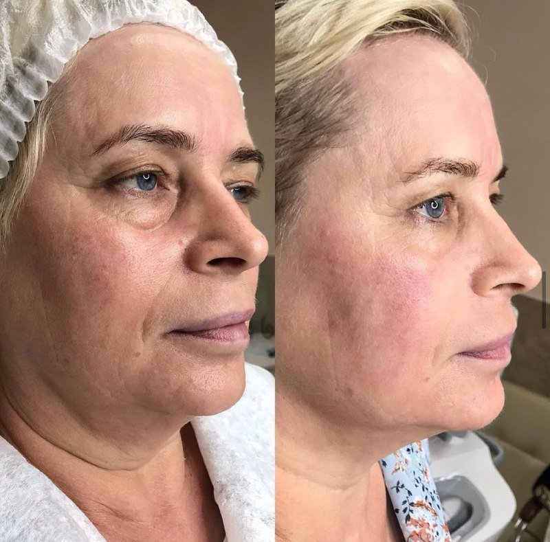 До і після SMAS-ліфтингу, фото 3 — Smart Beauty Clinic, Кривий Ріг