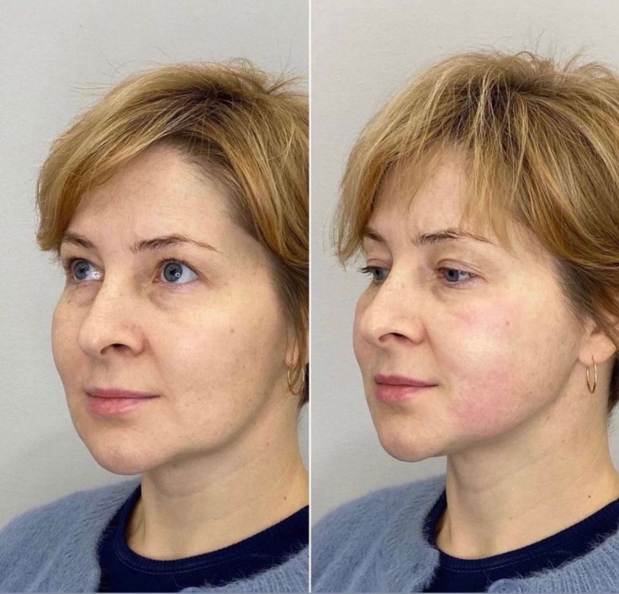 До і після SMAS-ліфтингу, фото 2 — Smart Beauty Clinic, Кривий Ріг