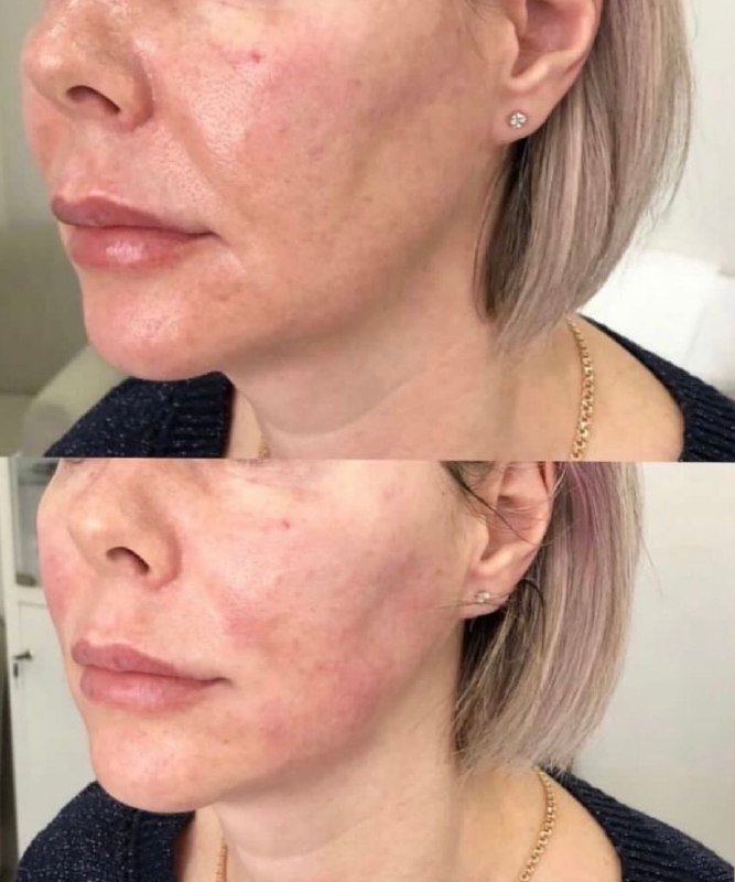 До і після SMAS-ліфтингу, фото 1 — Smart Beauty Clinic, Кривий Ріг