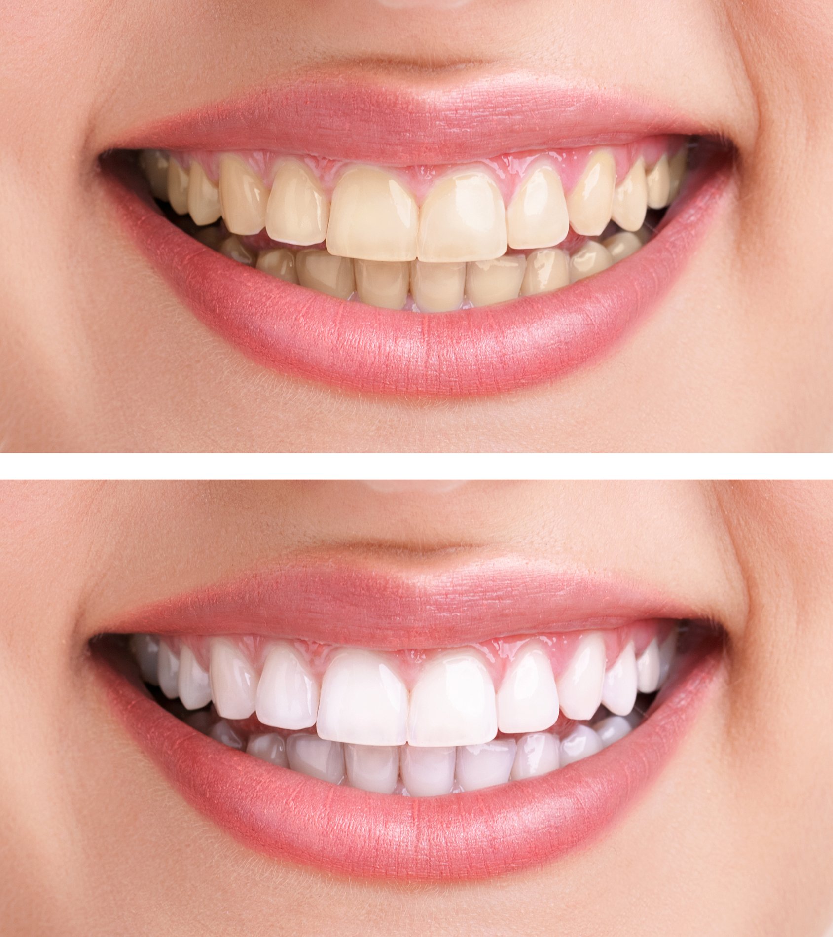 Smile transformation — before and after