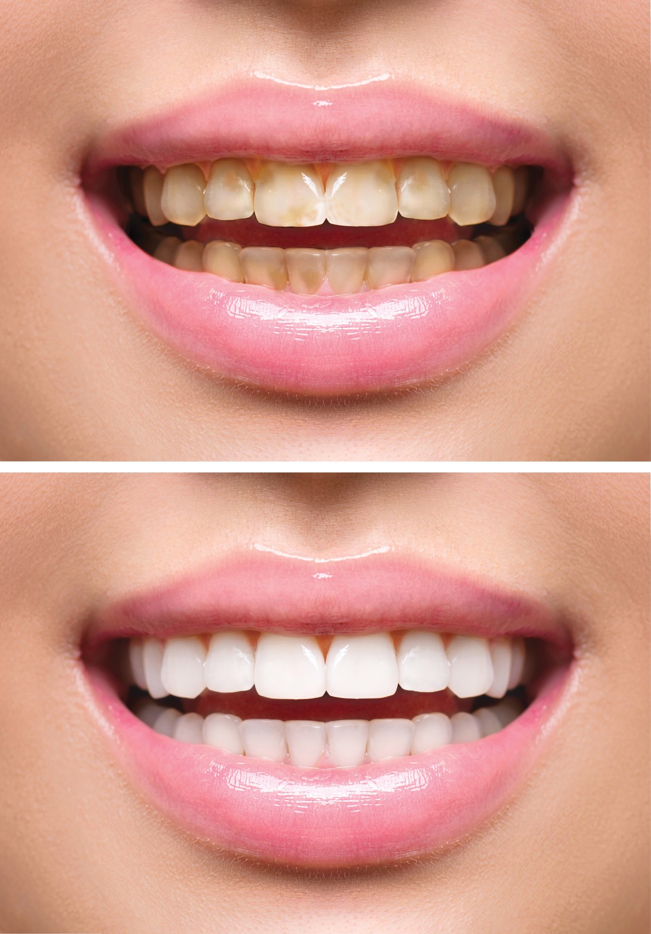 Smile transformation — before and after