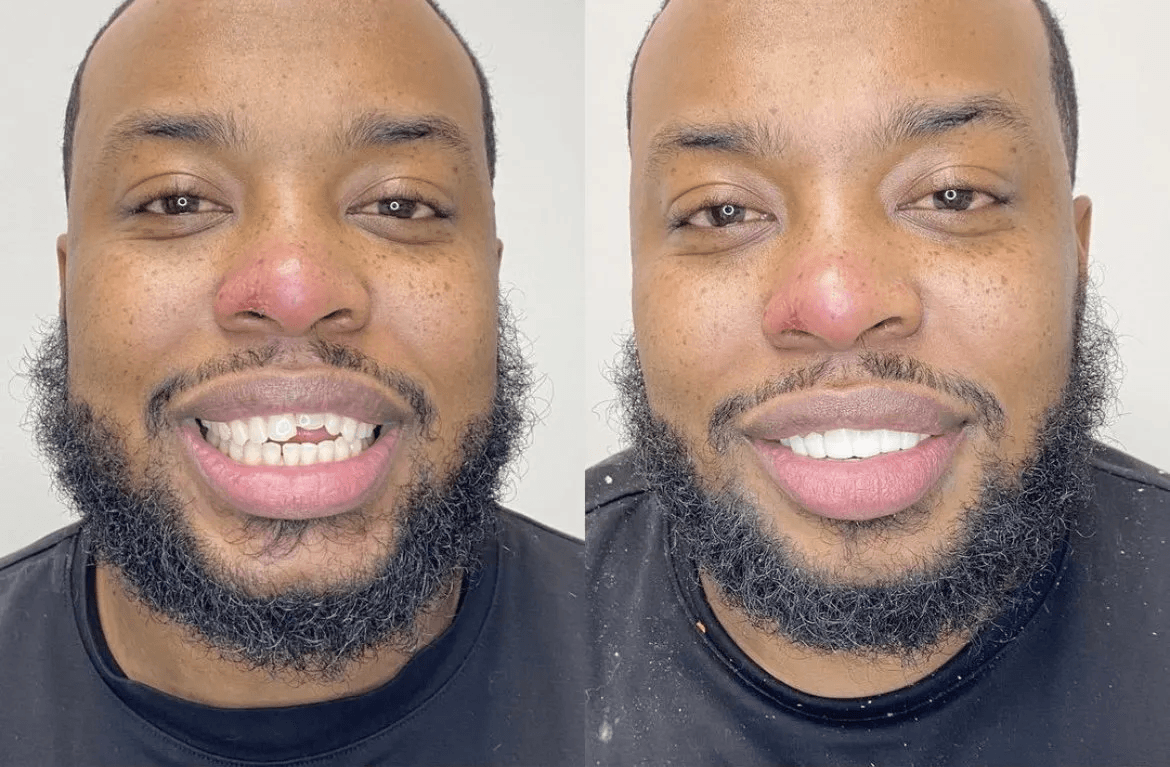 Smile transformation — before and after