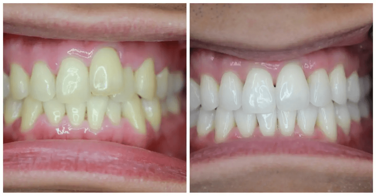 Smile transformation — before and after