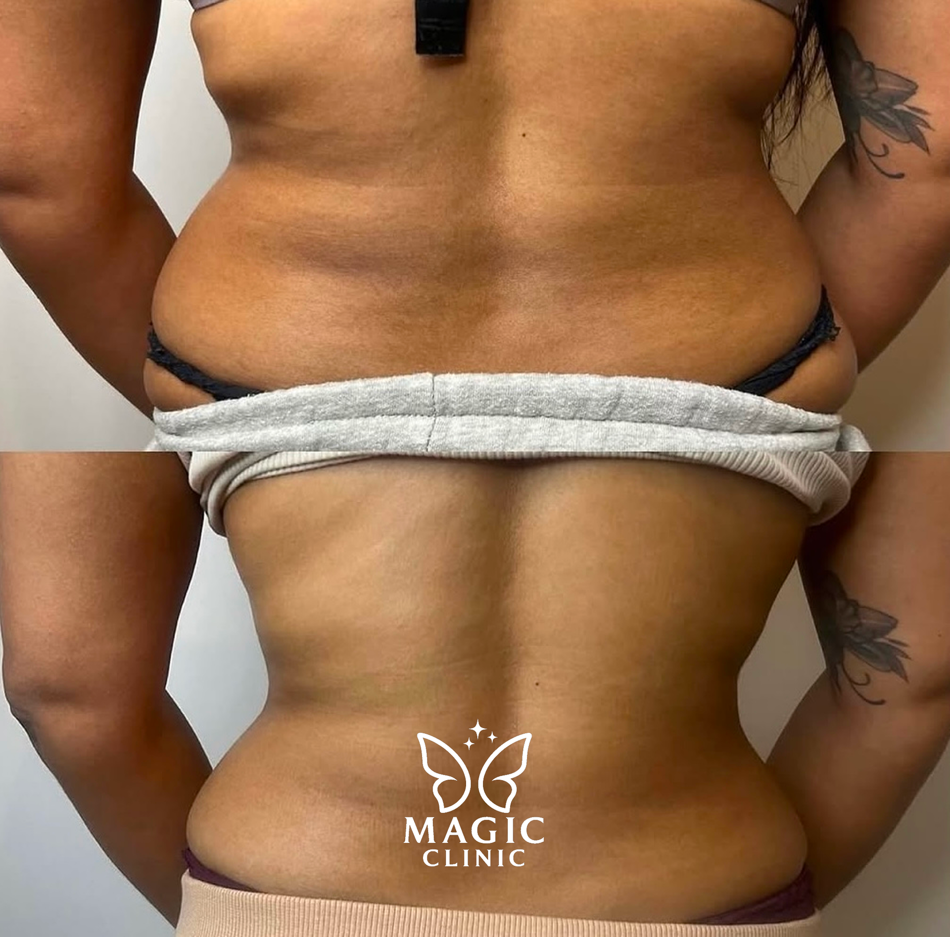LIPOFIRE